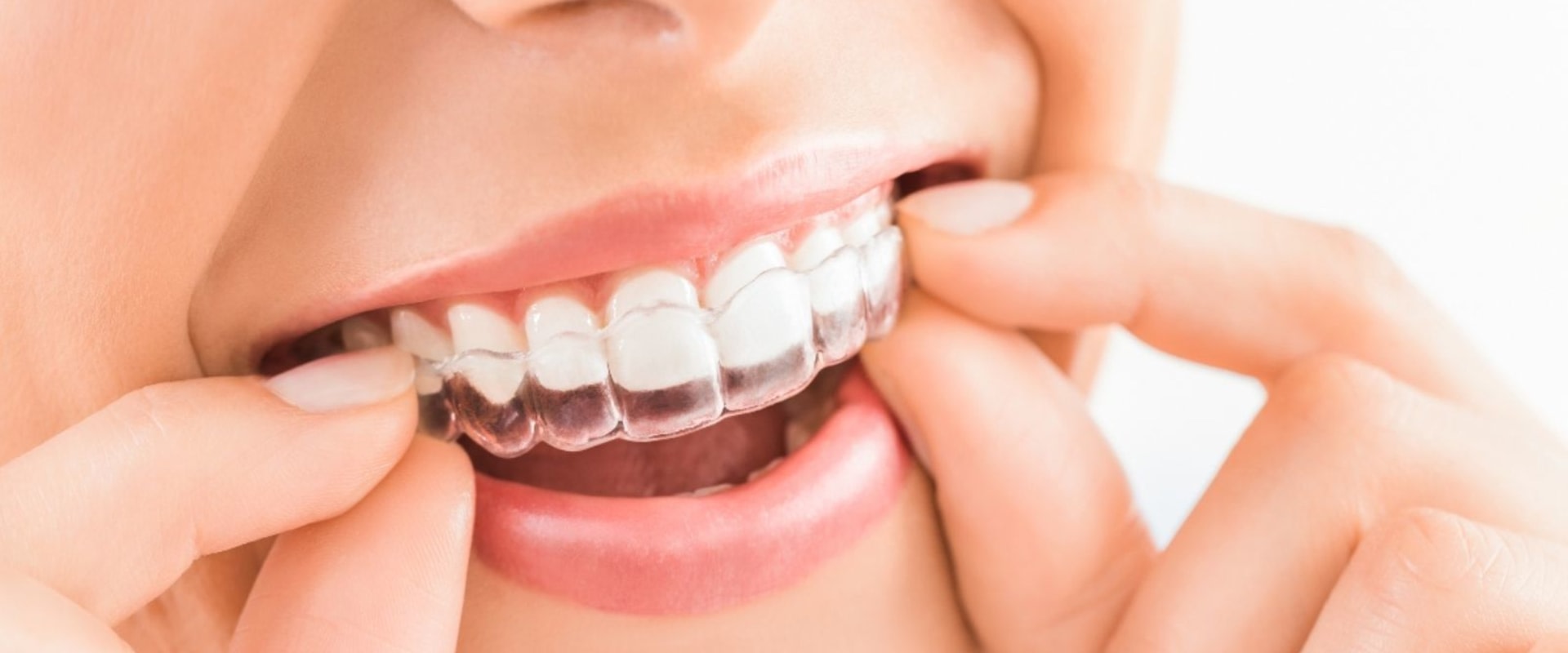 Emergency Dental Hospital In London How An Invisalign Dentist Saves