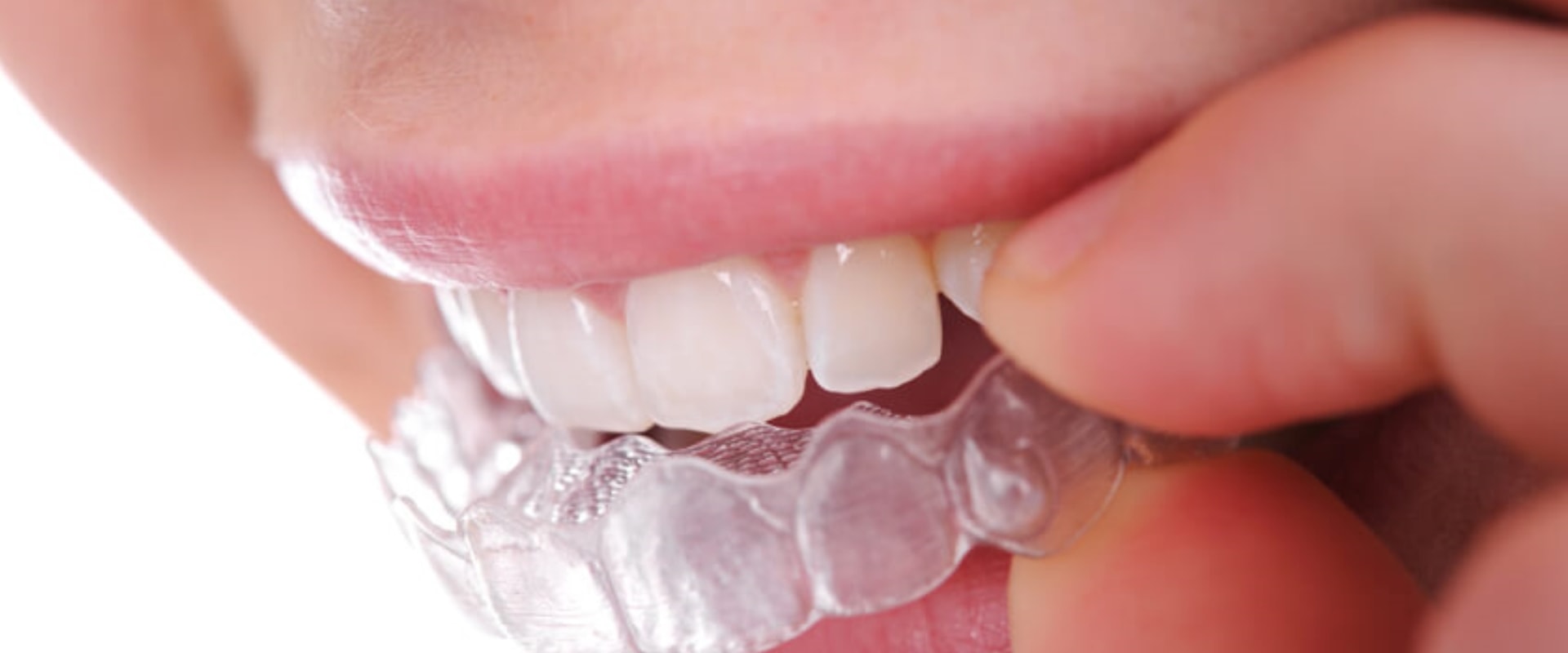 Why A Invisalign Dentist Is The Best Choice For Your Orthodontic Needs