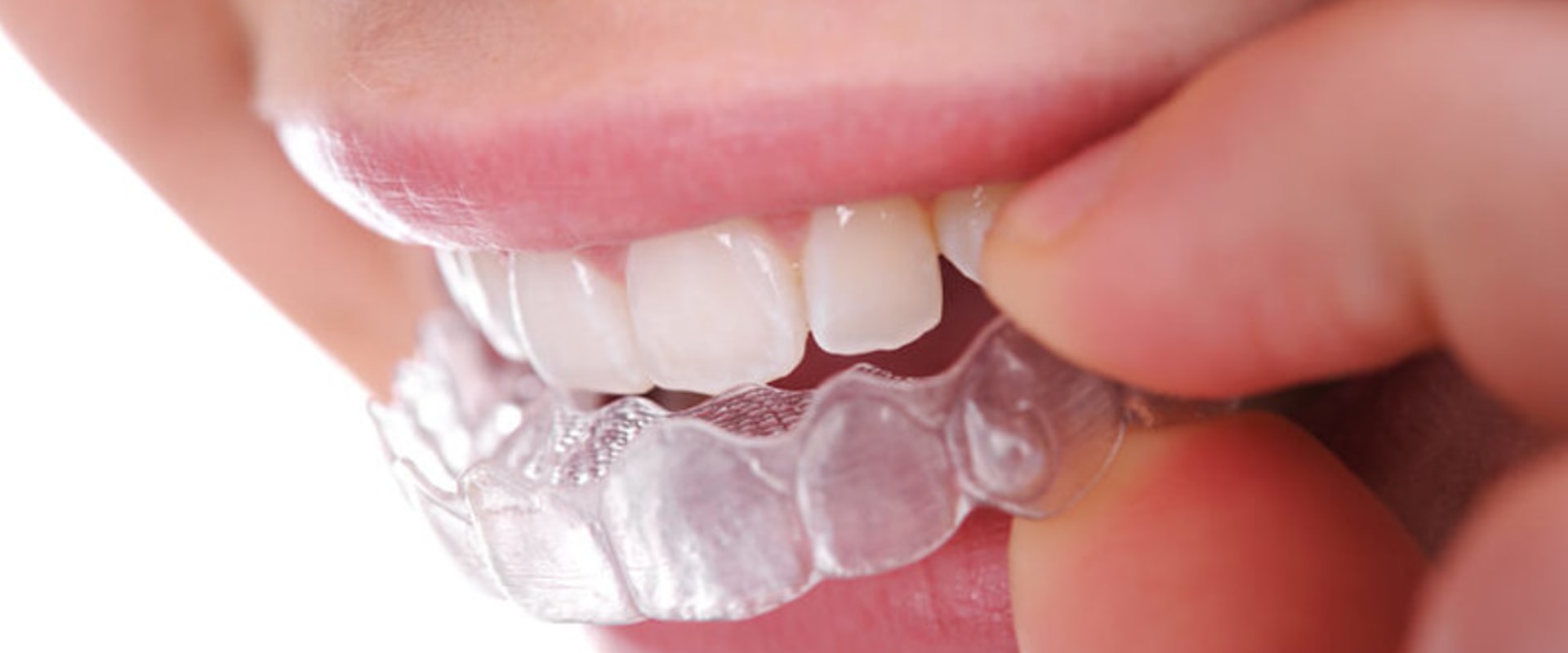 Invisalign In Austin A Comprehensive Guide To The Clear Aligner Treatment