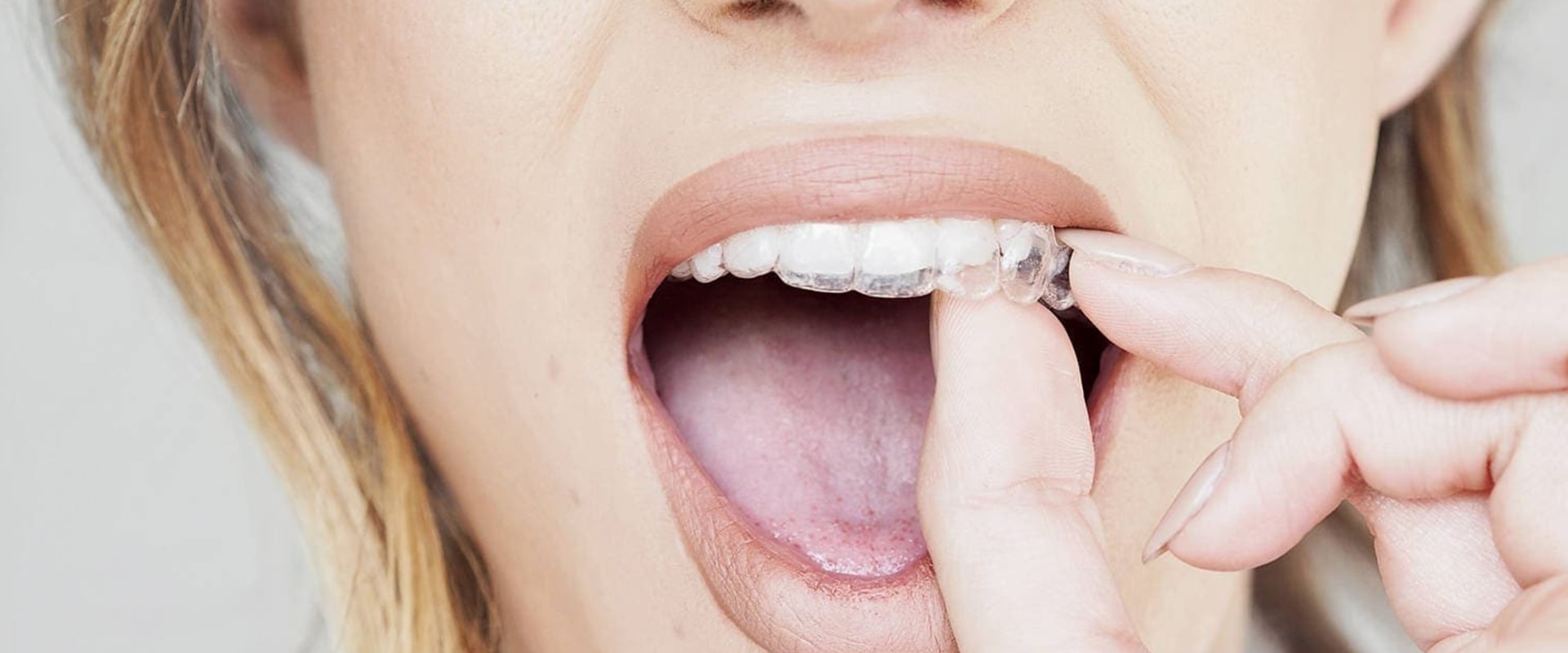 What do Orthodontists Really Think of Invisalign?
