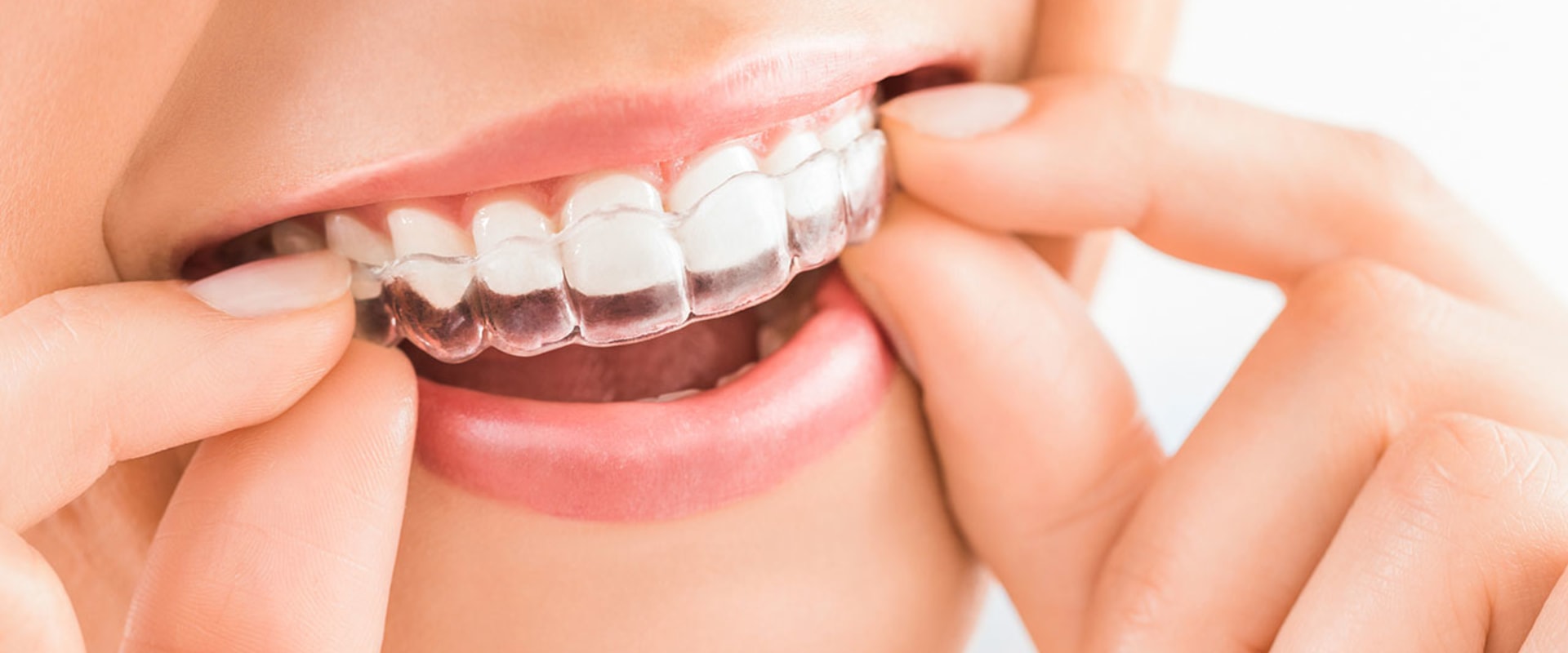 Do All Dentists Offer Invisalign Treatment?