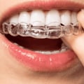 The Benefits Of Invisalign: Why More McGregor Residents Are Choosing Clear Aligners