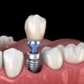 Discover the Benefits of Metal-Free Dental Implants in Zurich