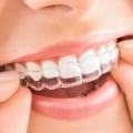 Smile Transformation Starts Here: How To Choose An Invisalign Dentist In Ashburn, VA