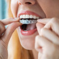 What To Look For When Searching For A Qualified Invisalign Dentist In Georgetown And South Austin