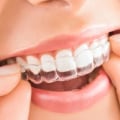 Emergency Dental Hospital In London: How An Invisalign Dentist Saves The Day