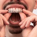 How Long Does it Take to Achieve a Perfect Smile with Invisalign?