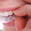 Why A Georgetown Invisalign Dentist Is The Best Choice For Your Orthodontic Needs