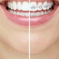 5 Tips to Choose the Best Invisalign Orthodontist