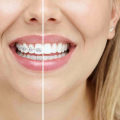 Straighten Your Teeth In Style With Invisalign: Meet Your Sydney Invisalign Dentist