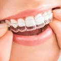 How to Get the Most Out of Your Invisalign Appointment