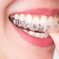 Finding The Right Invisalign Dentist For You In Mansfield, Texas