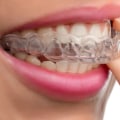 6 Steps to Get Invisalign Treatment from a Dentist