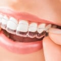 Achieve a Straighter Smile with Invisalign in Seattle