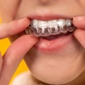 Smile Transformation: Finding The Right Invisalign Dentist In Spring Branch, TX