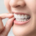 Straighten Your Teeth With Invisalign: Finding The Right Dentist In Taylor, TX