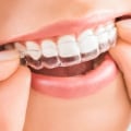 The Benefits of Invisalign Dentistry: A Comprehensive Guide