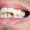 Achieve Your Dream Smile With Cosmetic Dentistry And Invisalign In Dripping Springs, TX