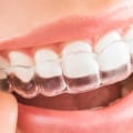 What Are the Risks of Invisalign Treatment from a Dentist?