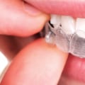 Can I Switch Dentists While Doing Invisalign Treatment?