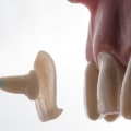 Transform Your Smile with Porcelain Veneers and Invisalign in Austin