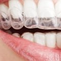 What is the Difference Between Invisalign Providers? A Comprehensive Guide