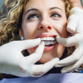 Straighten Your Teeth With Ease: Finding The Best Invisalign Dentist In Austin