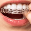 Can Invisalign Cause Root Damage? - An Expert's Perspective