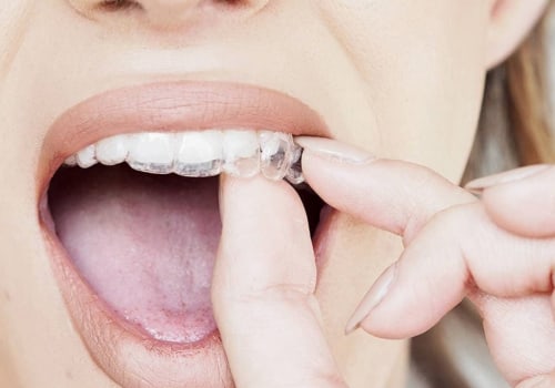 What Types of Insurance Plans Cover Invisalign Treatment from a Dentist?