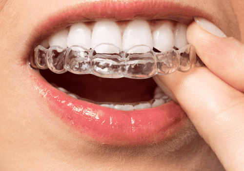 The Benefits Of Invisalign: Why More McGregor Residents Are Choosing Clear Aligners
