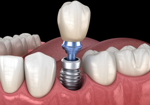Discover the Benefits of Metal-Free Dental Implants in Zurich