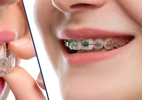 What is the Difference Between an Orthodontist and an Invisalign Dentist?