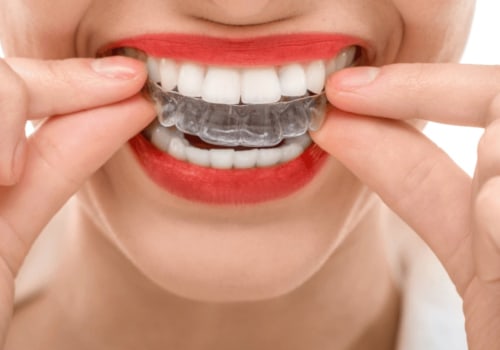 How Long Does It Take to See Results with Invisalign Treatment?