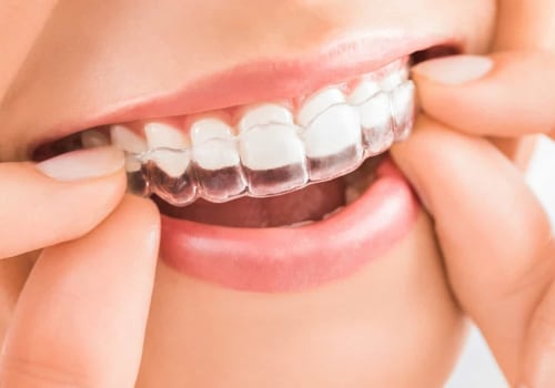 Straighten Your Teeth Discreetly With Invisalign: A Guide To Finding The Right Dentist In Woden