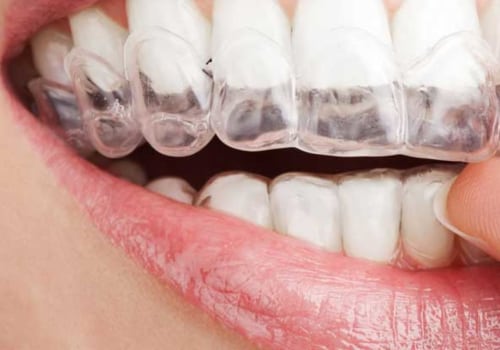 Straighten Your Teeth In Style: What Your Invisalign Dentist Can Do For You In Boerne, TX