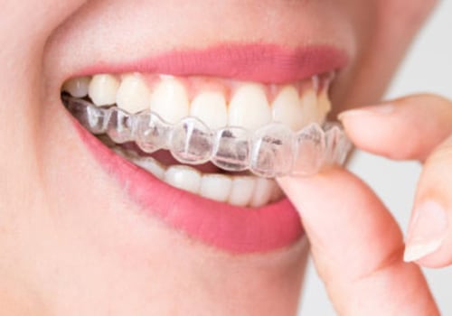 Finding The Right Invisalign Dentist For You In Mansfield, Texas