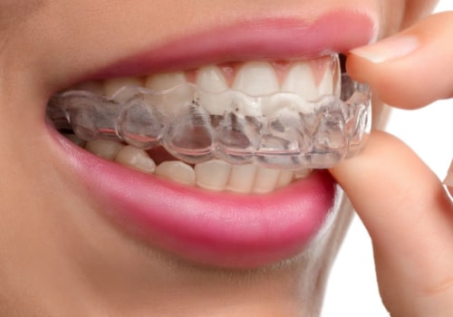 6 Steps to Get Invisalign Treatment from a Dentist
