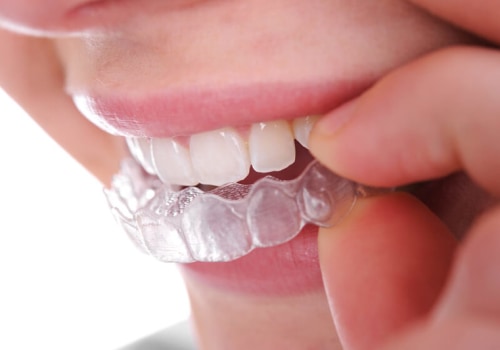 Invisalign In Austin: A Comprehensive Guide To The Clear Aligner Treatment