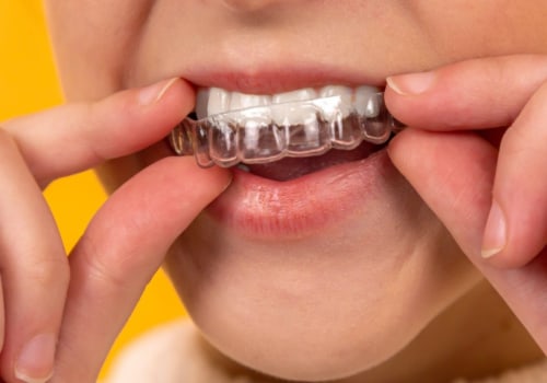 Smile Transformation: Finding The Right Invisalign Dentist In Spring Branch, TX