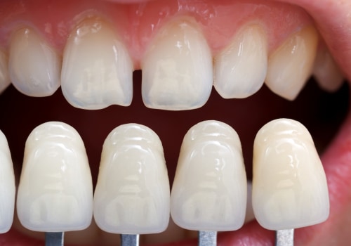 Are Porcelain Veneers Right For You? Find Out From Round Rock, TX's Invisalign Dentist Experts