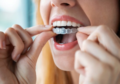 A Perfect Smile Starts Here: Finding The Right Invisalign Dentist In Taylor, Texas