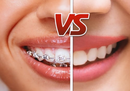 Invisalign vs Braces: Which Orthodontic Appliance is Best for You?