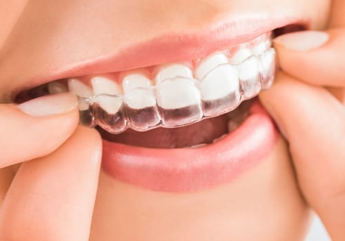 Do I Need a Referral to See an Invisalign Dentist?