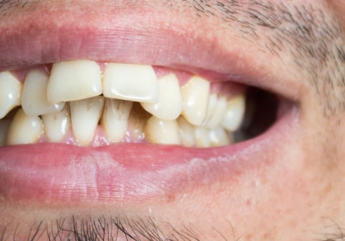 How Long Does It Take to Achieve a Perfect Smile with Invisalign Treatment?