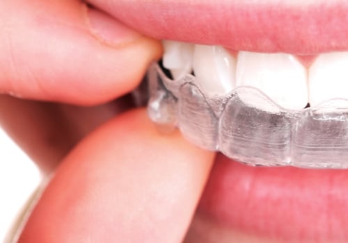 Can Invisalign Cause Fillings to Fall Out?